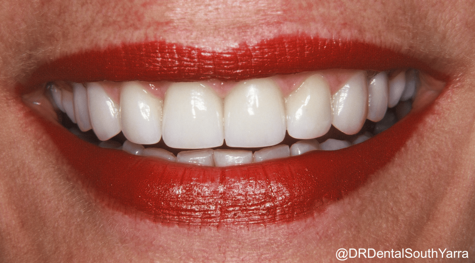 DR Dental Before and After Gallery South Yarra Dr Derry Rogers